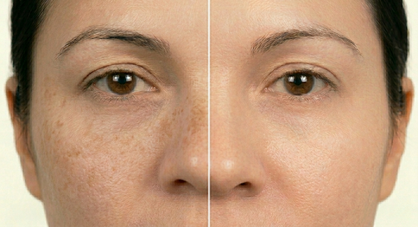 Post-inflammatory hyperpigmentation