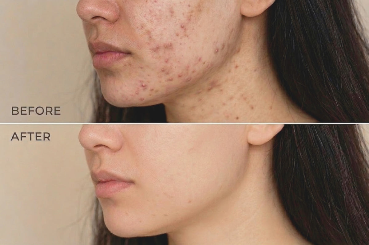 Acne and texture