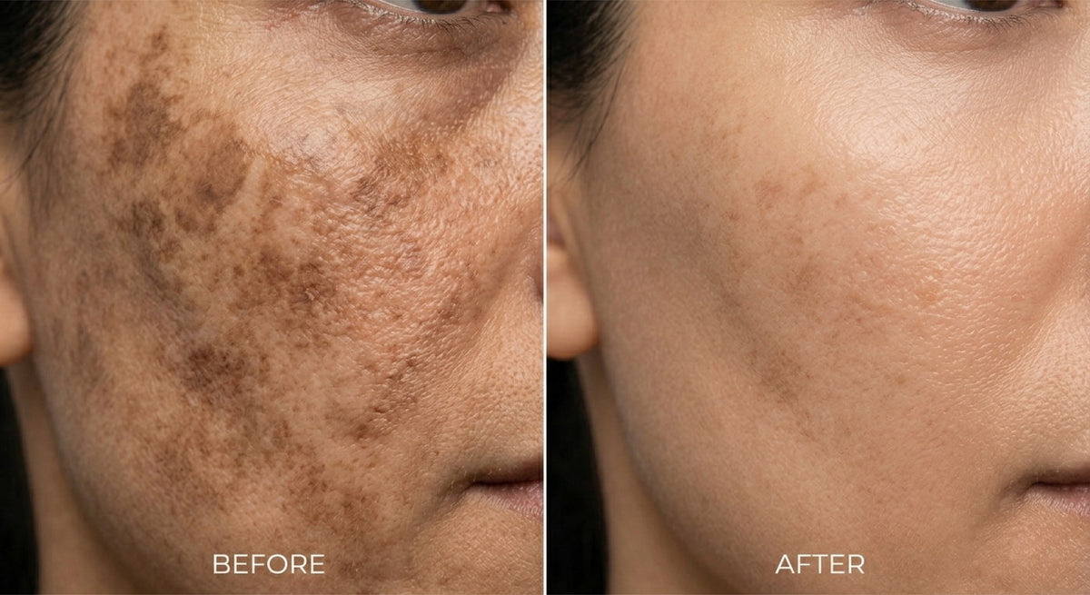 Pigmentation