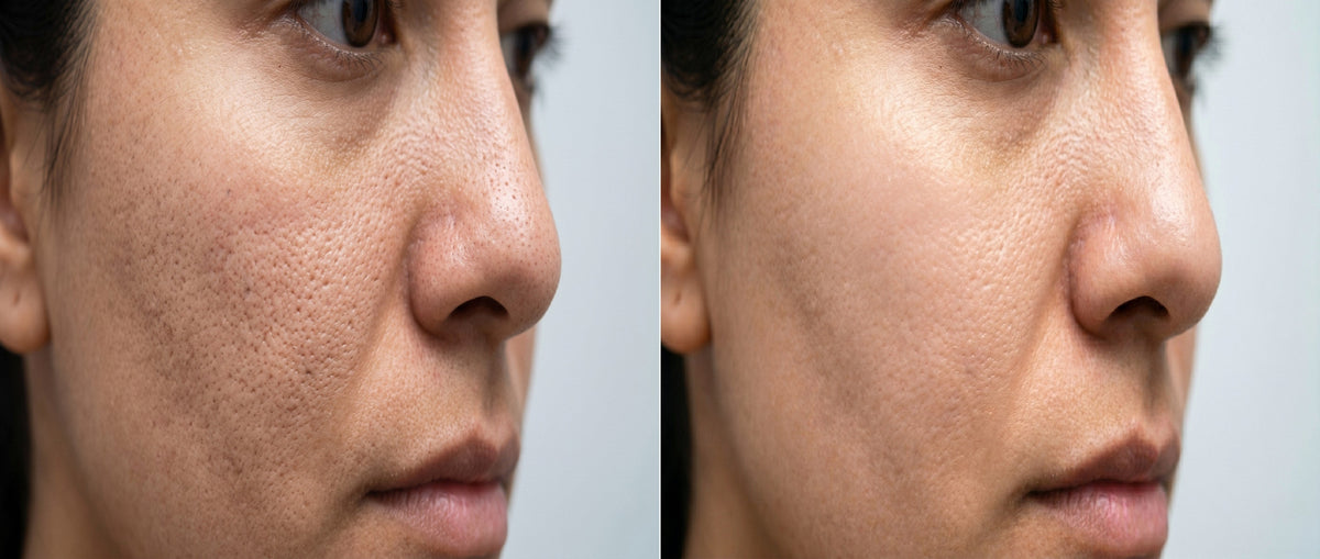 Nose and cheek texture