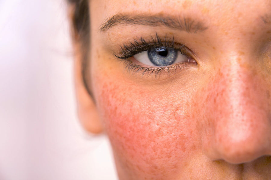 IPL for rosacea and persistent flushing