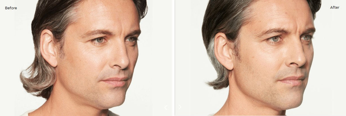 Cheek volume restoration (men)
